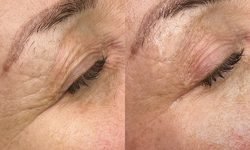 Standalone Treatment